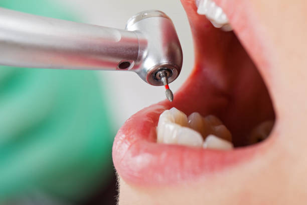 Best Emergency Wisdom Teeth Removal in Reading, OH